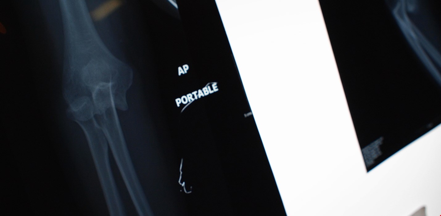 Recovering Damaged X-Rays